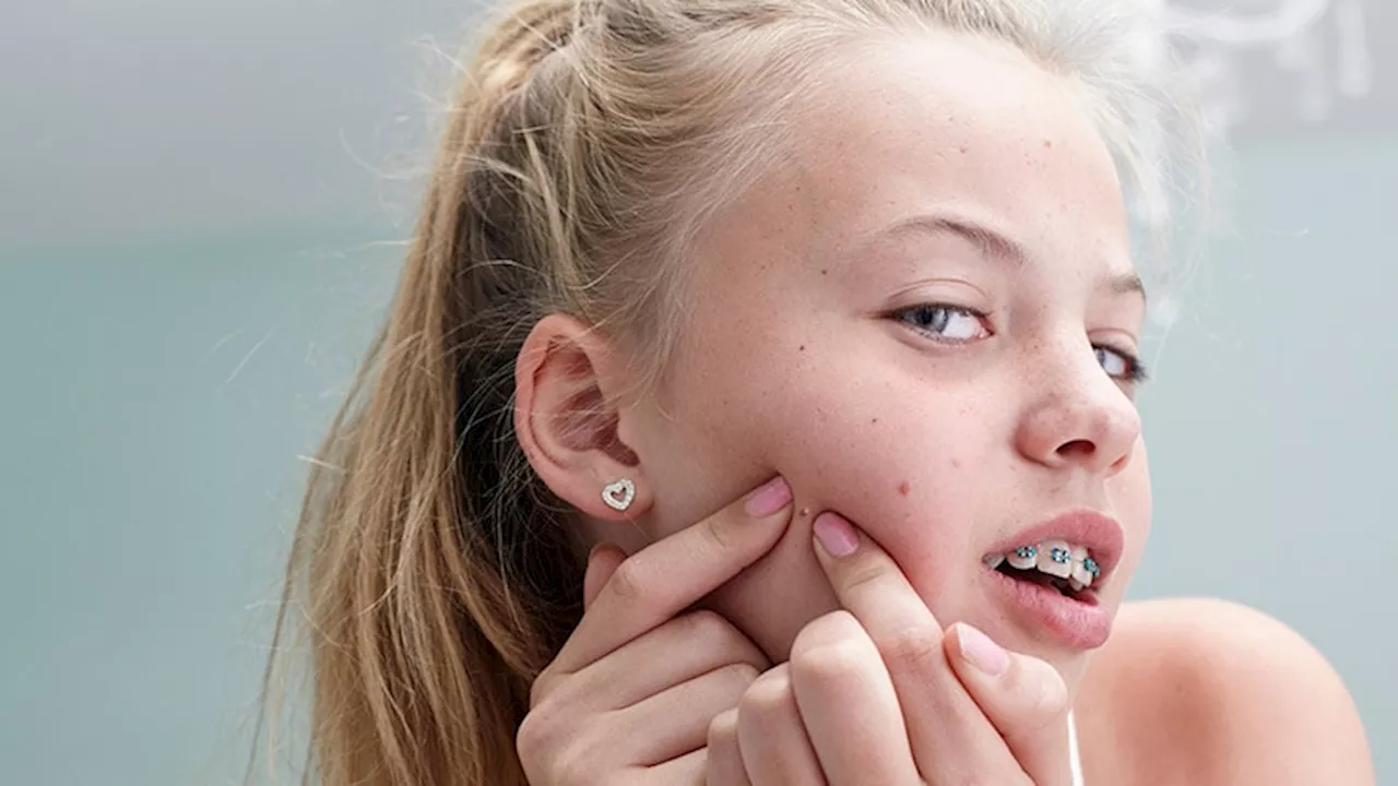 Consider Emergency Contraception for Teens With Acne