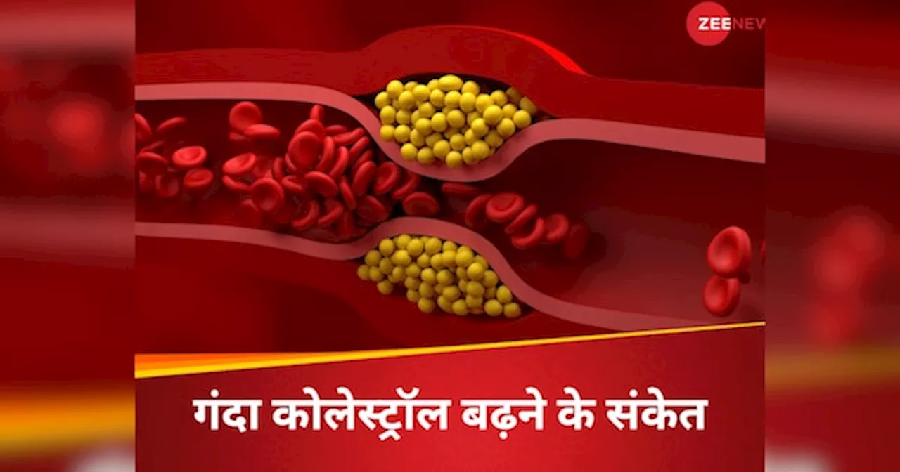 100 mgdl से बढ़ा गंदा कोलेस्ट्रॉल, तो दिल पर टूट पड़ेंगी बीमारियां, समझें LDL Cholesterol के बढ़ने के 5 लक्षण