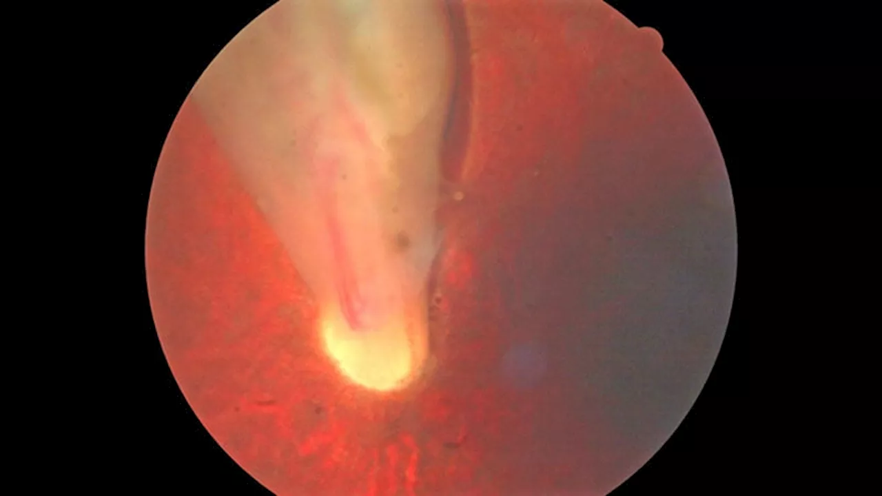 Registry Study: Eyes After Cataract Surgery Do Worse With In-Office Retina Repair