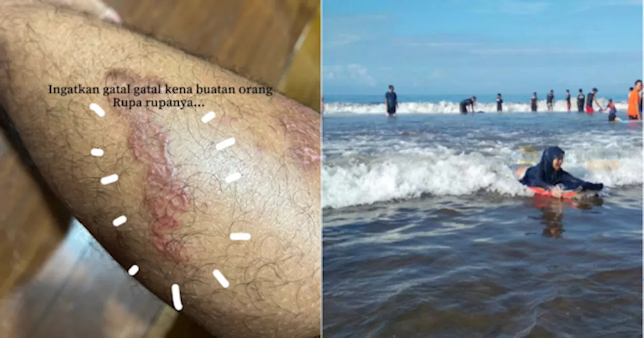 Badan Naik Ruam & Gatal-Gatal, Lelaki Dedah Punca Sebenar Sebab Mandi Pantai. Seram!