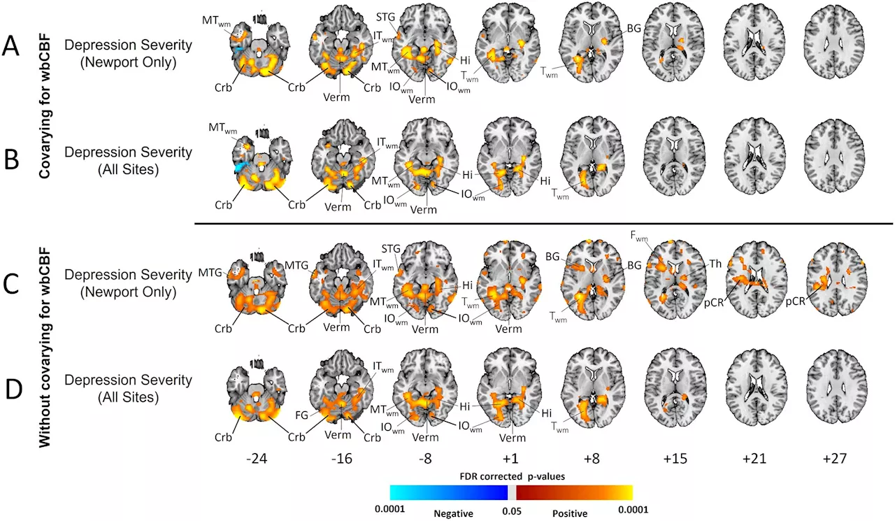 Behavioral health researchers study hundreds of brain scans to explore the biology of depression