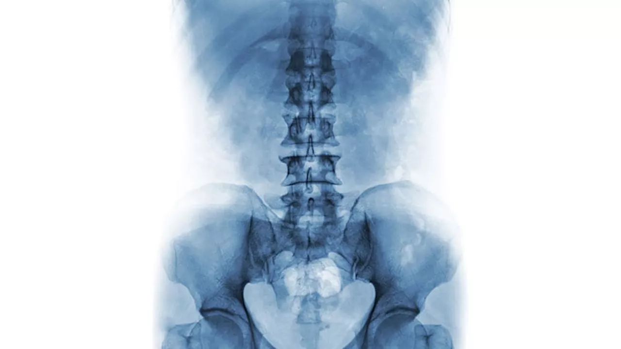 Axial Involvement in Psoriatic Arthritis Still Defies Definition