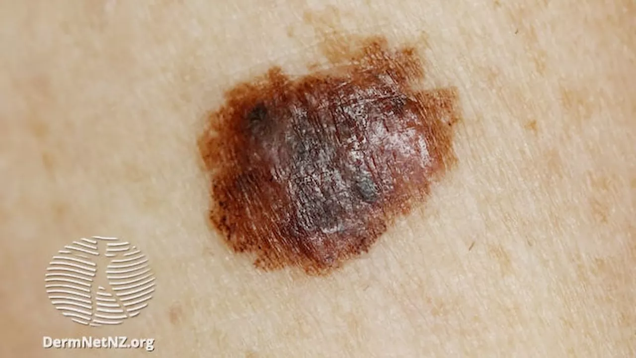 Does Dabrafenib-Trametinib Improve Overall Survival in Melanoma?