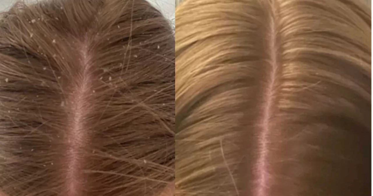 Beauty fans 'floored' by results of viral £14 scalp oil that 'banishes' dandruff