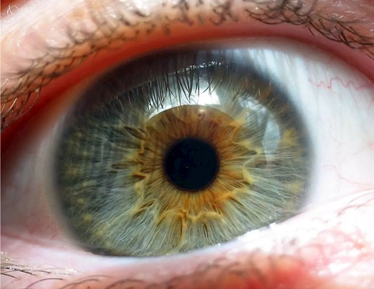 Study hints at a promising approach for treating wet age-related macular degeneration