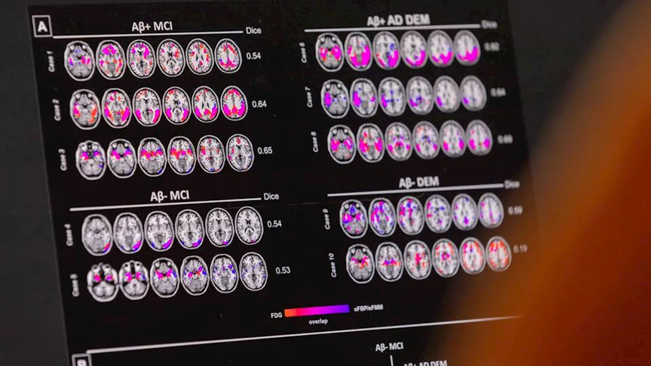 FDA approves new Alzheimer’s drug, expanding treatment options for patients