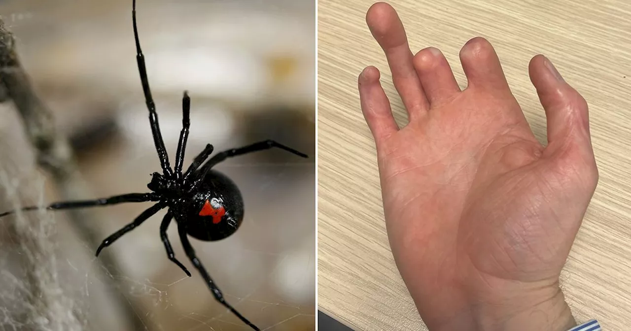 Man has fingers amputated after shocking spider bite on holiday in Ibiza