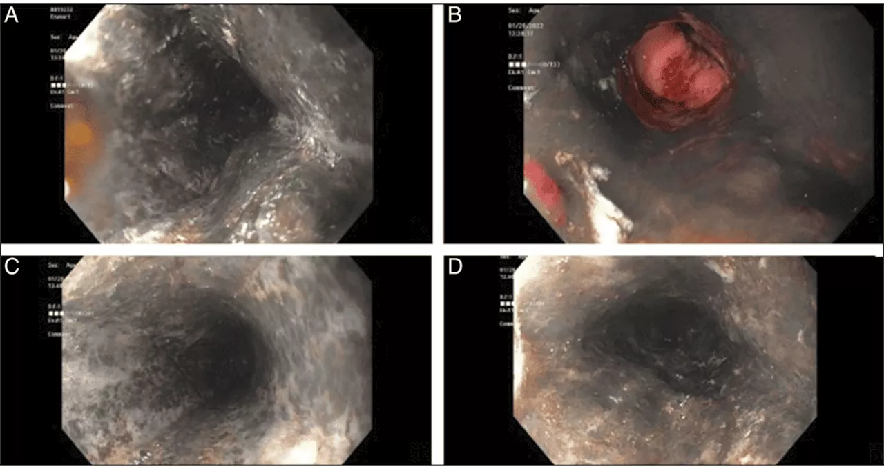 Descubren raro esófago negro o necrosis esofágica aguda en paciente con insuficiencia respiratoria
