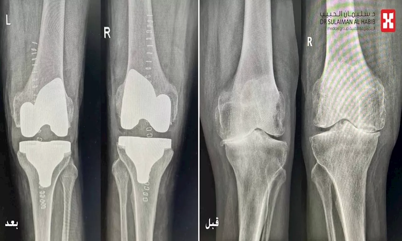 مجمع الدكتور سليمان الحبيب بالعُليا يُجري عملية ناجحة لاستبدال مفصلَي الركبة لـ'ثمانيني' بحالة صحية معقدة