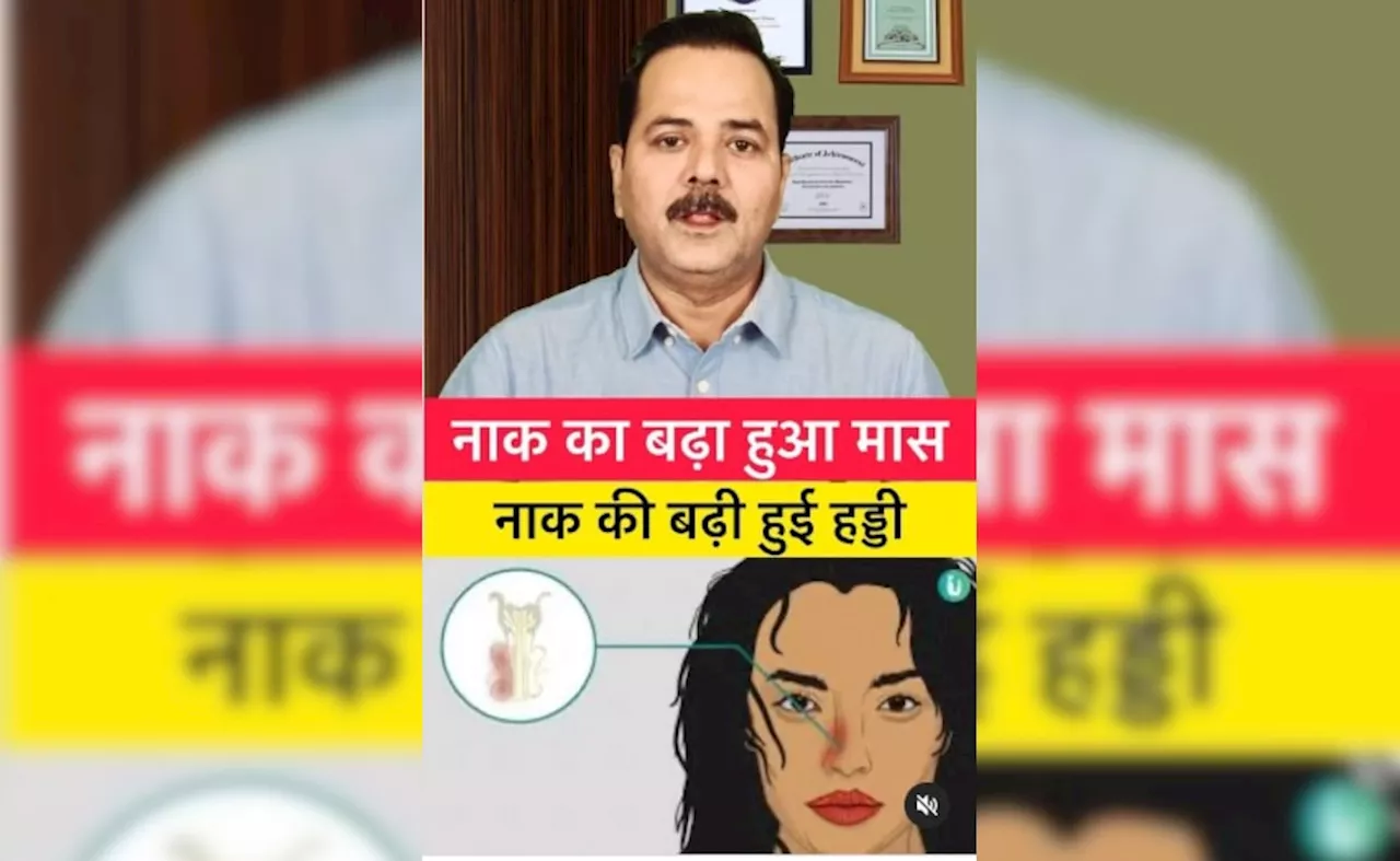 डॉक्टर के बताए इस घरेलू नुस्खे से नाक की बढ़ी हुई हड्डी और मास को कर सकते हैं ठीक, जानिए यहां