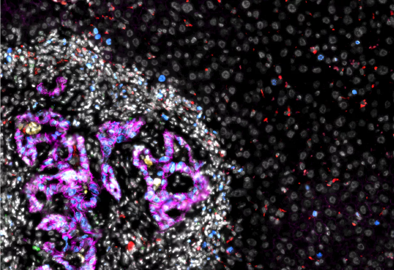 Researchers uncover how colorectal cancer cells colonize the liver