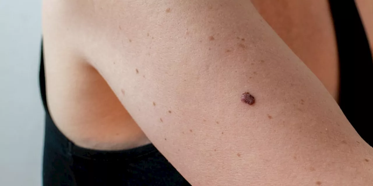 3 Types of Skin Cancer That Should Be on Everyone's Radar