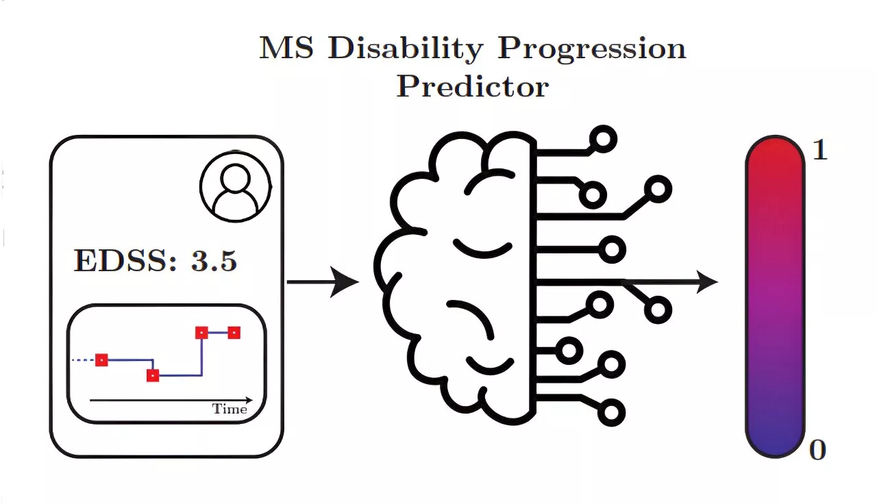 Machine learning shows potential for predicting multiple sclerosis progression