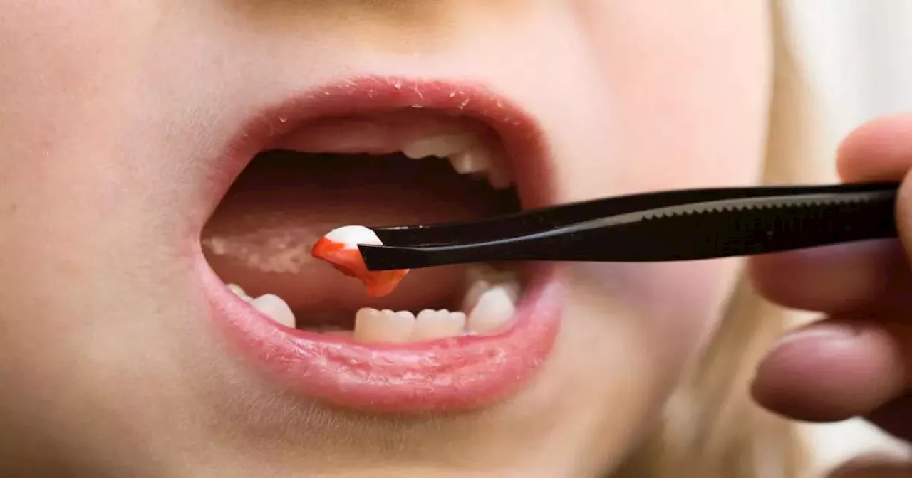 Tooth Extraction: दांत उखाड़वाने के बाद हो सकती है माउथ अल्सर की समस्या, जानिए इसका उपचार