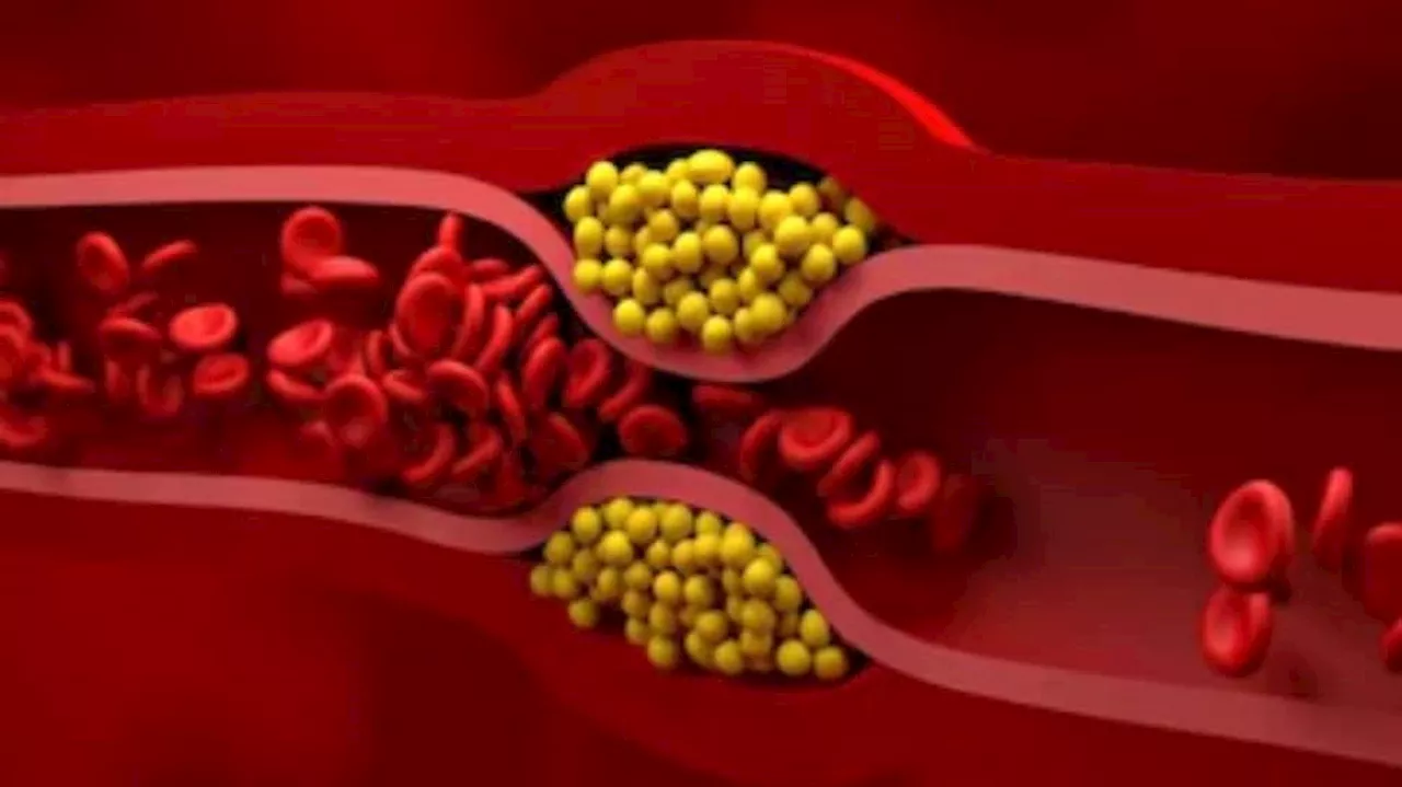 கொலஸ்ட்ரால் அடைப்பு என்றால் என்ன? இதன் அறிகுறிகளை தெரிந்துகொள்ளுங்கள்