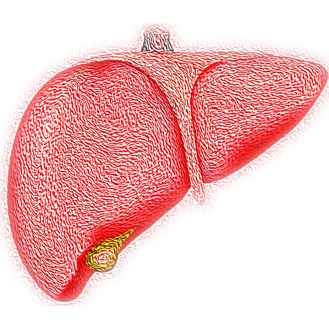 Study finds targeting inflammation may not help reduce liver fibrosis in metabolic-associated fatty liver disease