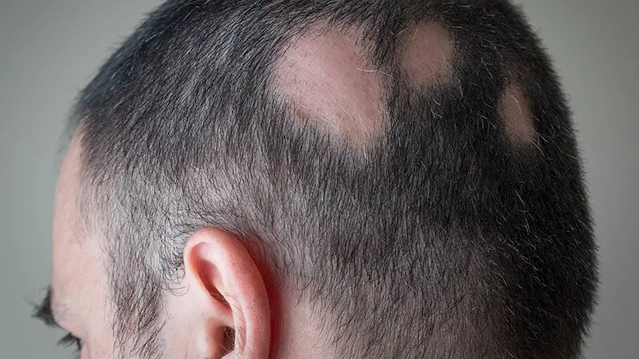 FDA Approves JAK Inhibitor Deuruxolitinib for Alopecia Areata