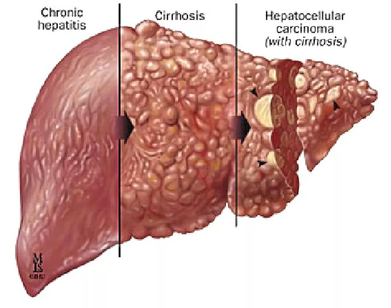 Get hepatitis diagnosed and treated fast before it ruins your liver