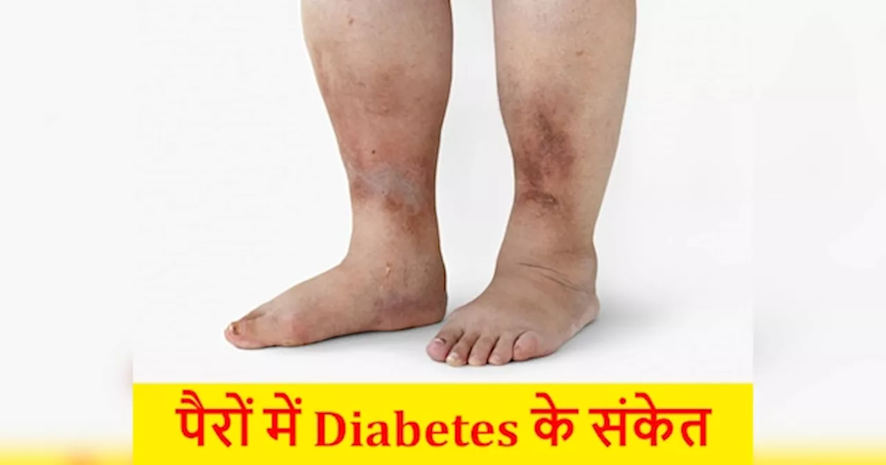 Diabetes Symptoms: पैरों में इस तरह मिलते हैं डायबिटीज के चेतावनी संकेत, एक्सपर्ट ने बताया कब करवाएं शुगर टेस्ट