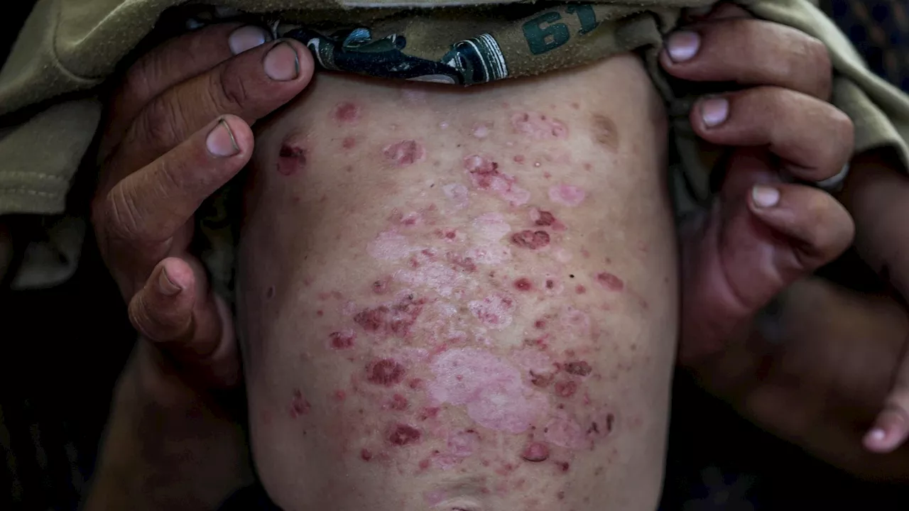 Lice, scabies, rashes plague children as skin disease runs rampant in Gaza's camps