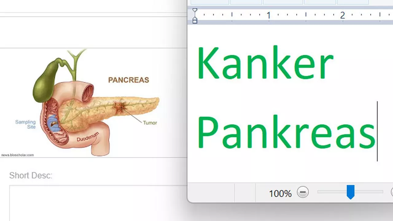 Kanker Pankreas Umumnya Baru Ditemukan di Tahap Lanjut, Bagaimana Menanganinya?