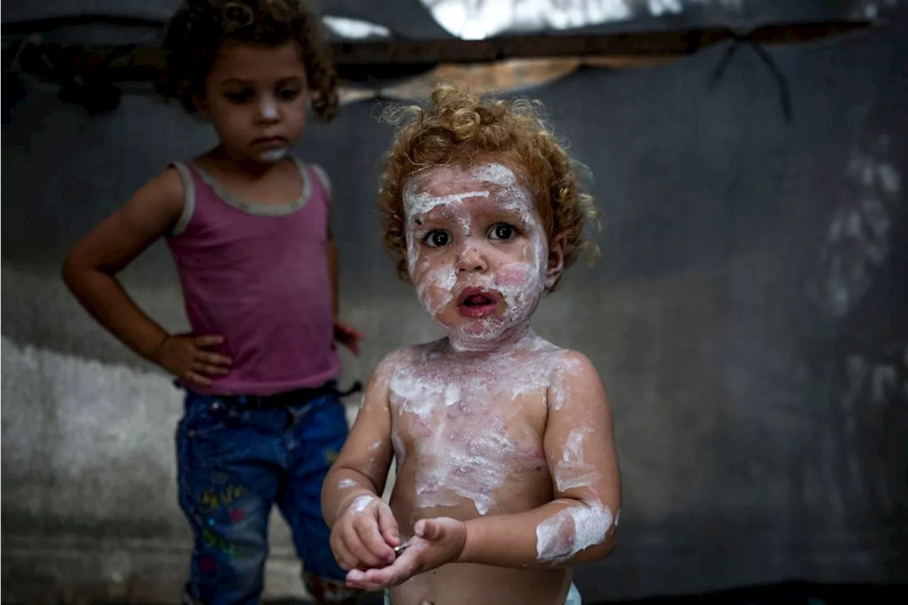 Lice, scabies, rashes plague Palestinian children as skin disease runs rampant in Gaza's tent camps