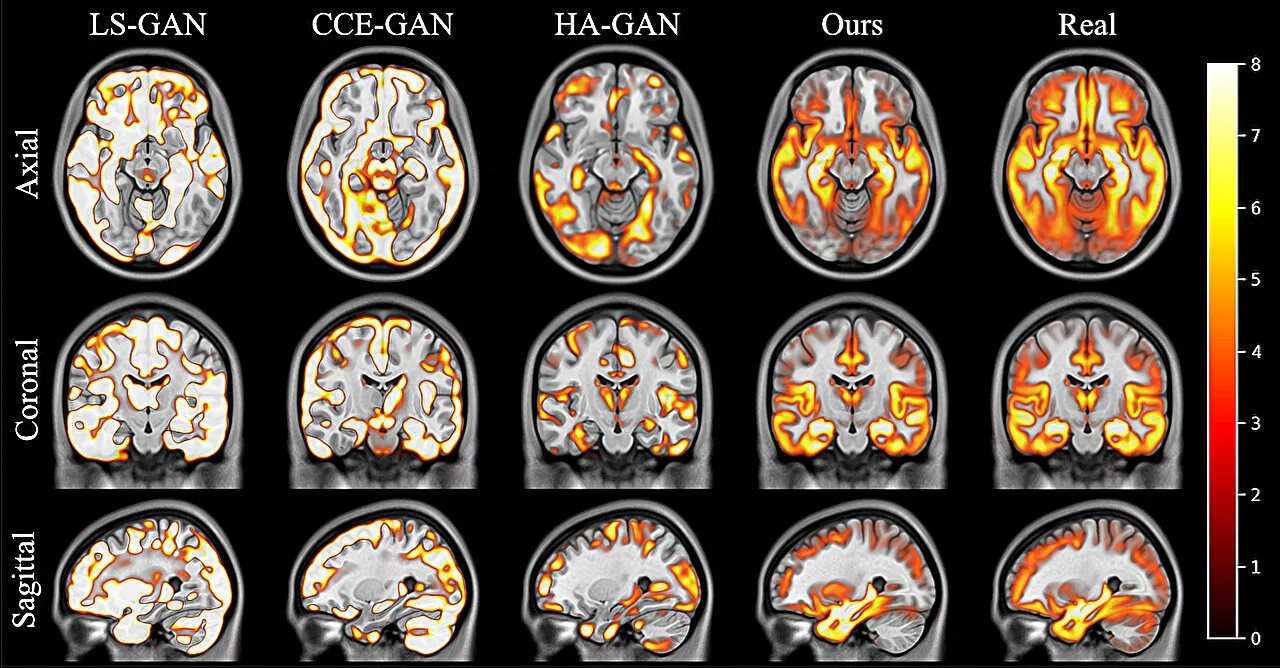 AI brain images create realistic synthetic data to use in medical research