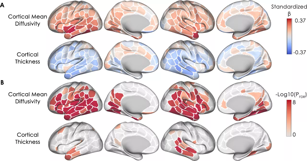 Spatial pattern of pathological changes in the brain can help identify dementia vulnerability early