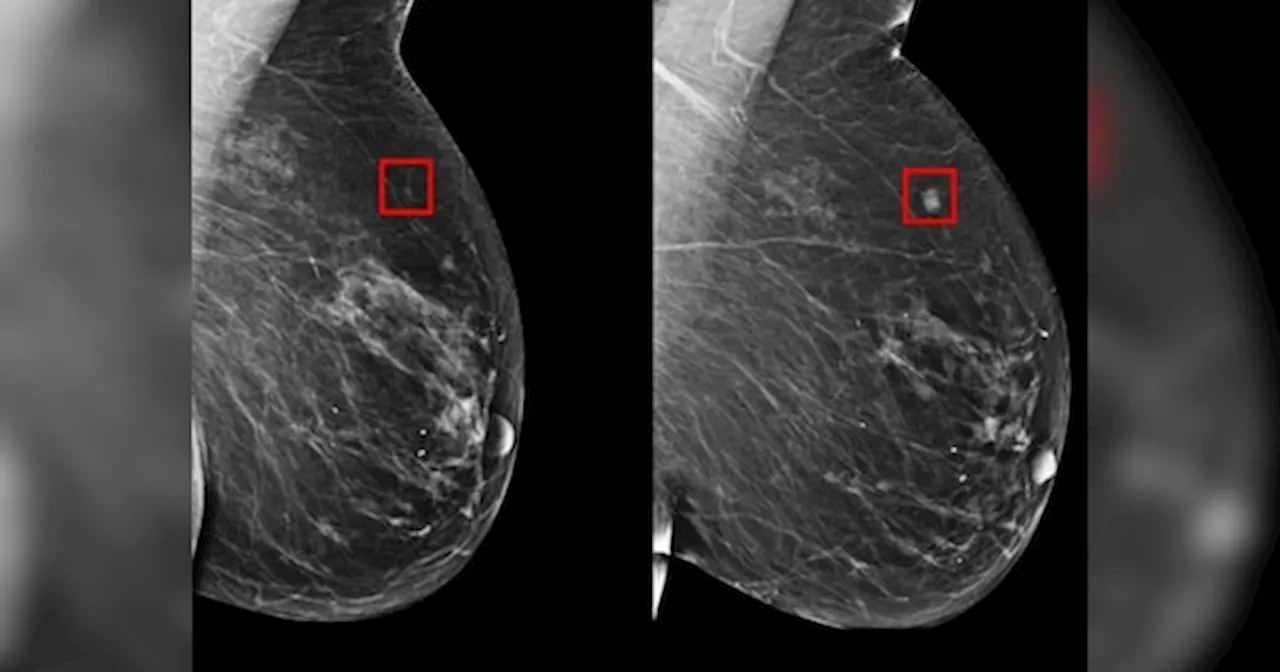ब्रेस्ट कैंसर होने से 5 साल पहले ही AI ने लगाया पता, नई खोज ने बढ़ाई उम्मीद