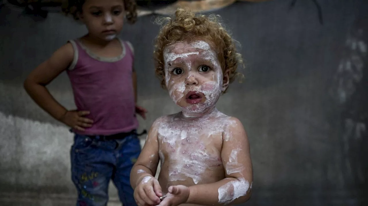 Lice, scabies, rashes plague Palestinian children as skin disease runs rampant in Gaza's tent camps