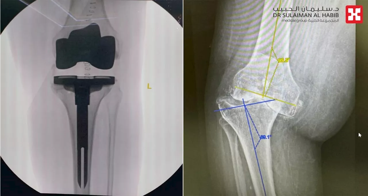 مستشفى الدكتور سليمان الحبيب بالفيحاء في جدة ينهي معاناة 'سبعيني' بعملية نوعية لاستبدال مفاصل الركبتين