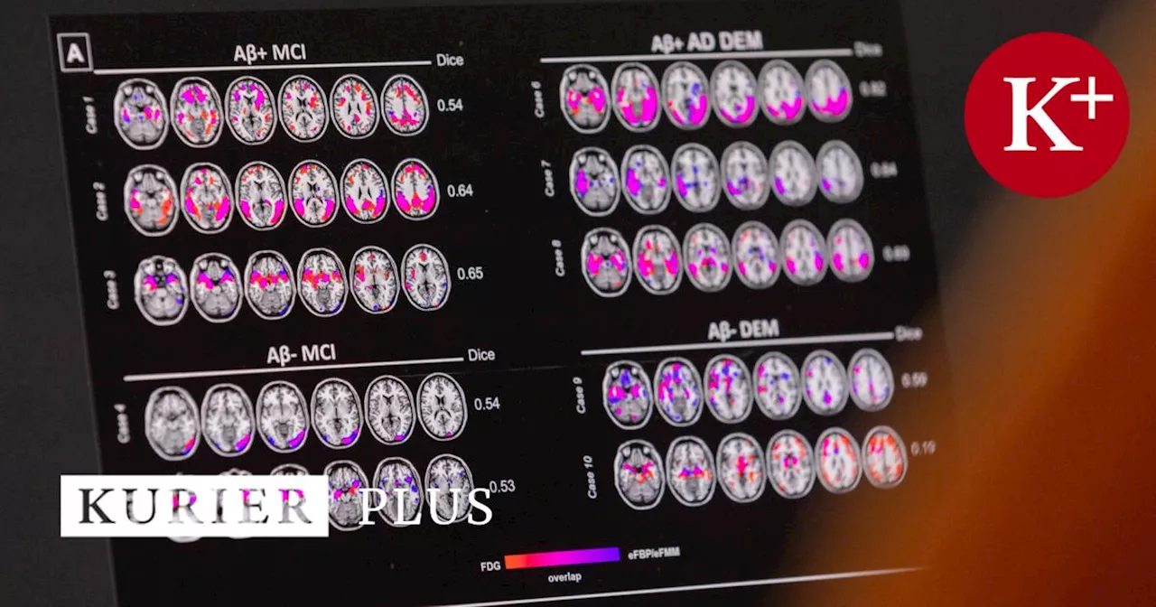 US-Behörde lässt weiteres Medikament zur frühen Alzheimer-Therapie zu