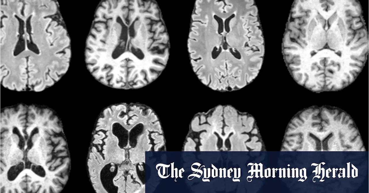 Diagnosing dementia is complicated. An algorithm could change that