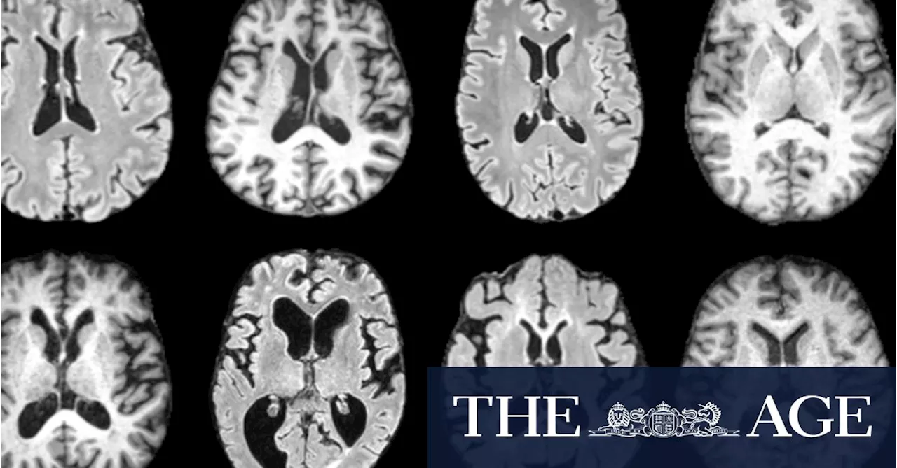 Diagnosing dementia is complicated. An algorithm could change that