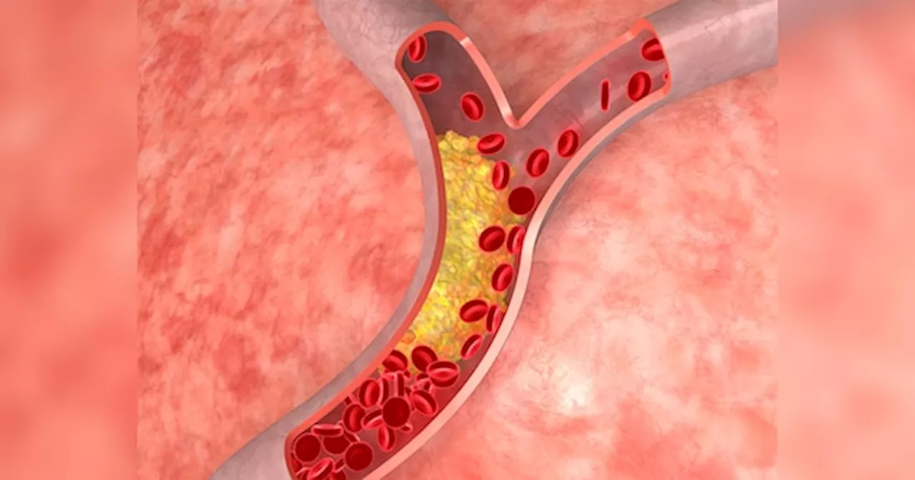 High Cholesterol: कोलेस्ट्रॉल घटाना चाहते हैं तो भूलकर भी न खाएं ये चीजें, डॉक्टर ने दी चेतावनी