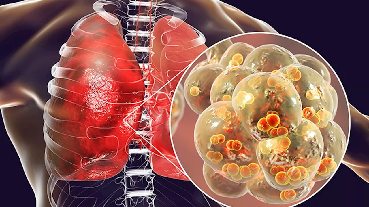 Specific Antipsychotics Linked to Increased Pneumonia Risk