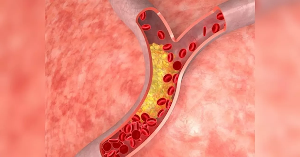 हाई कोलेस्ट्रॉल: अब नहीं होगा साइलेंट किलर का डर! भारत को मिली लिपिड कंट्रोल करने की अपनी पहली गाइडलाइंस