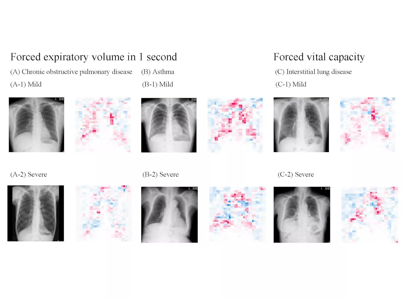 Highly accurate AI model can estimate lung function just by using chest X-rays