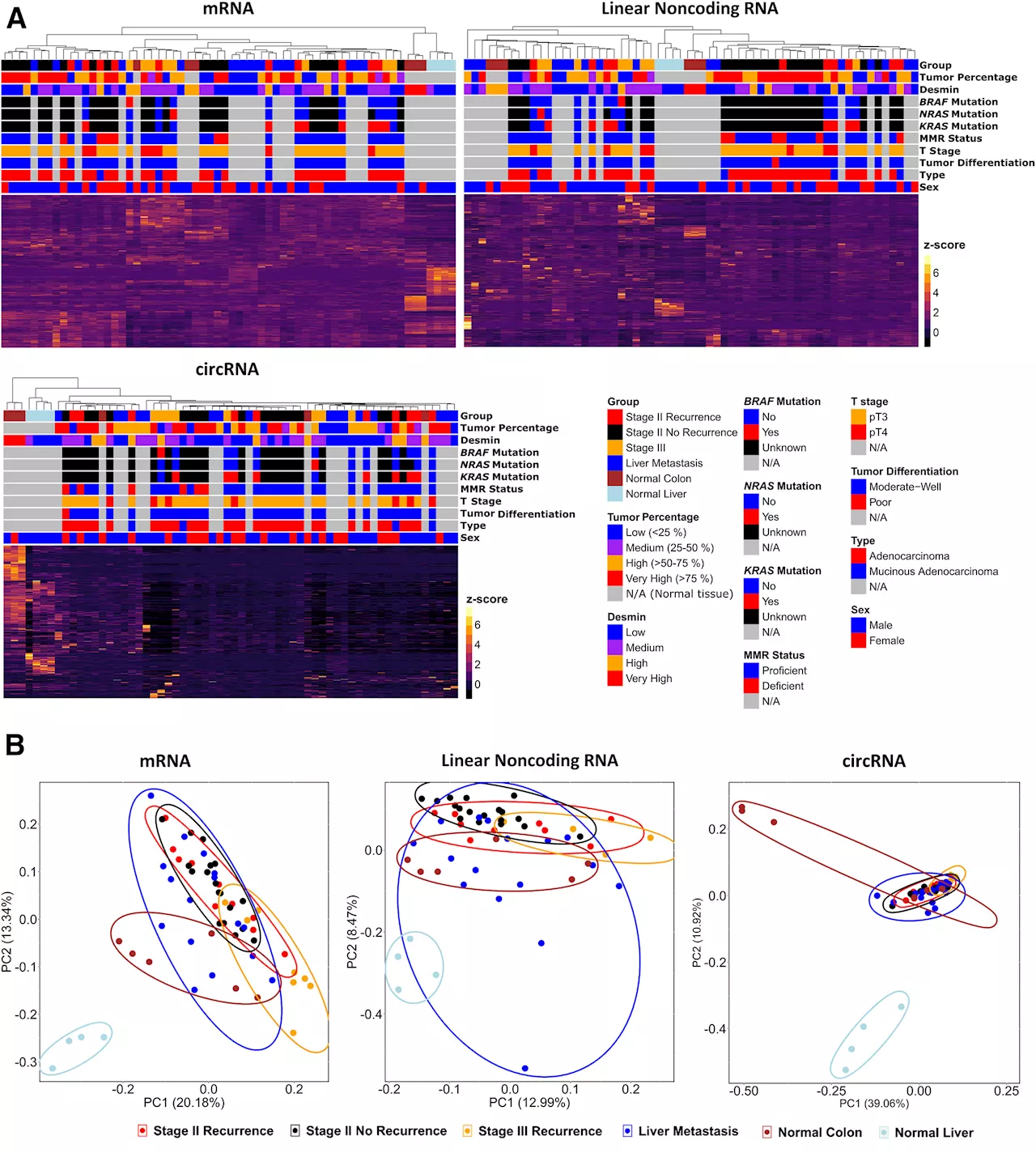 RNAs may help identify stage II colon cancer patients who could benefit from chemotherapy following surgery