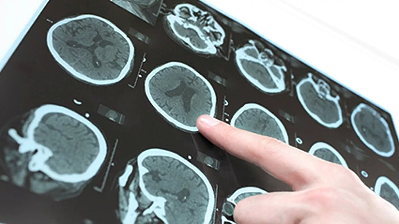 Structure, function of brain connectome tied to gray matter atrophy in Parkinson disease