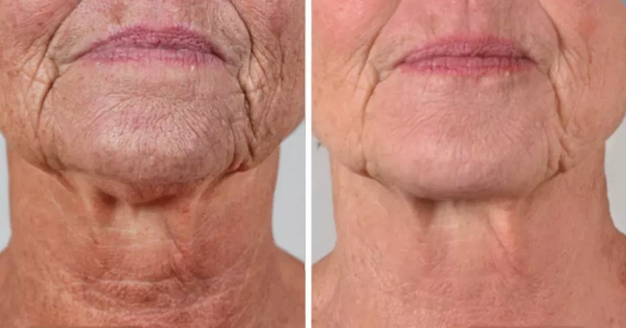 At-home laser device claims to banish 'tech-neck' and wrinkles