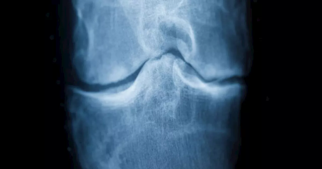 Diagnose Arthrose? Das können Sie nun selbst tun