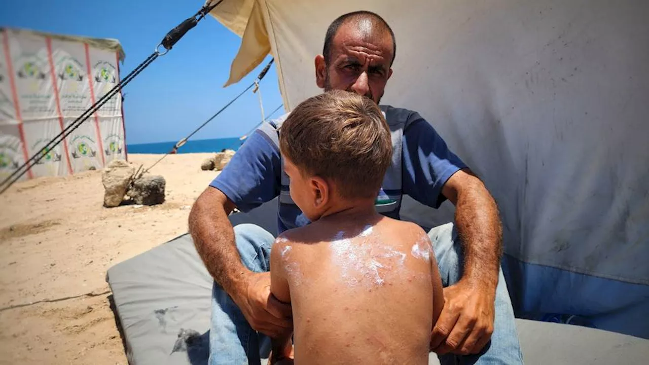 300 days of war: Gaza's humanitarian crisis deepens, new epidemics rise