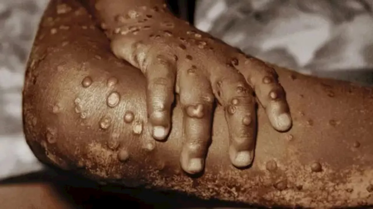 Nigeria, other African nations on red alert as deadlier version of mpox spreads