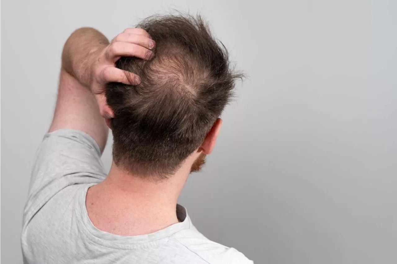 Minoxidil, finasterida e outros: benefícios e riscos de medicamentos contra a calvície