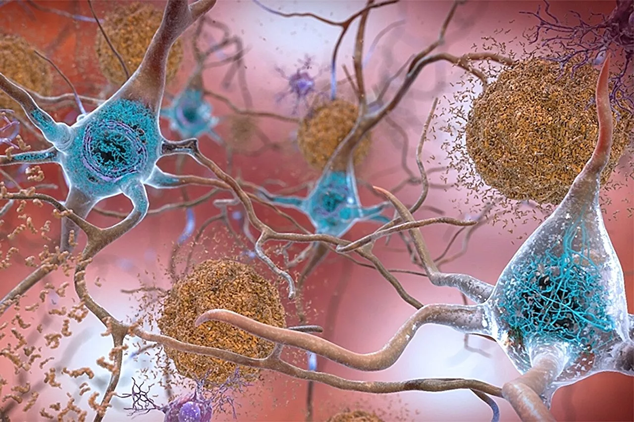 New findings suggest alternative mechanisms behind Alzheimer's disease