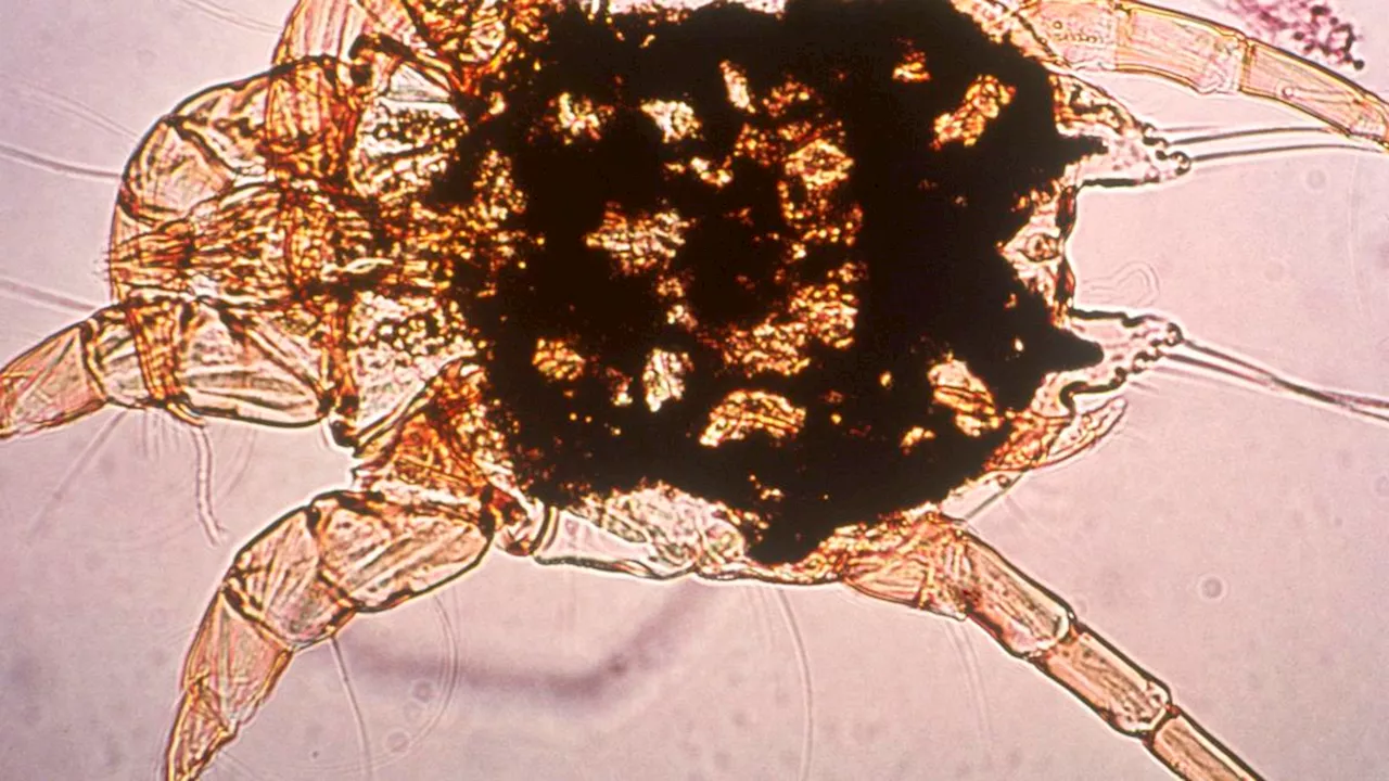 Scabies outbreak grows, infecting 48 people across four NSW hospitals