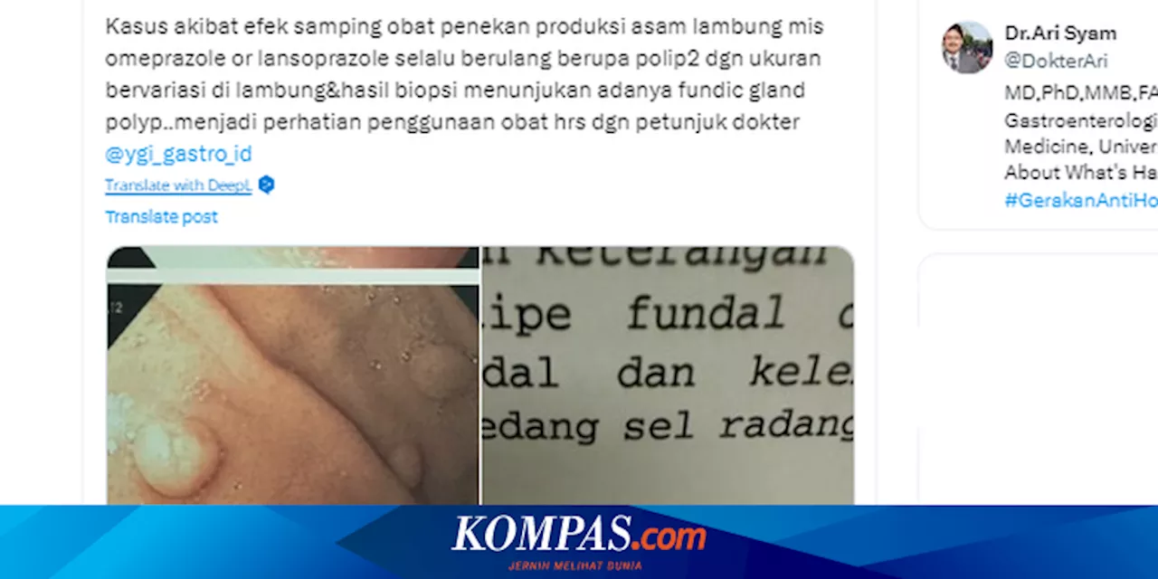 Minum Omeprazole dan Lansoprazole Bisa Picu Polip Lambung, Ini Penjelasan Guru Besar UI