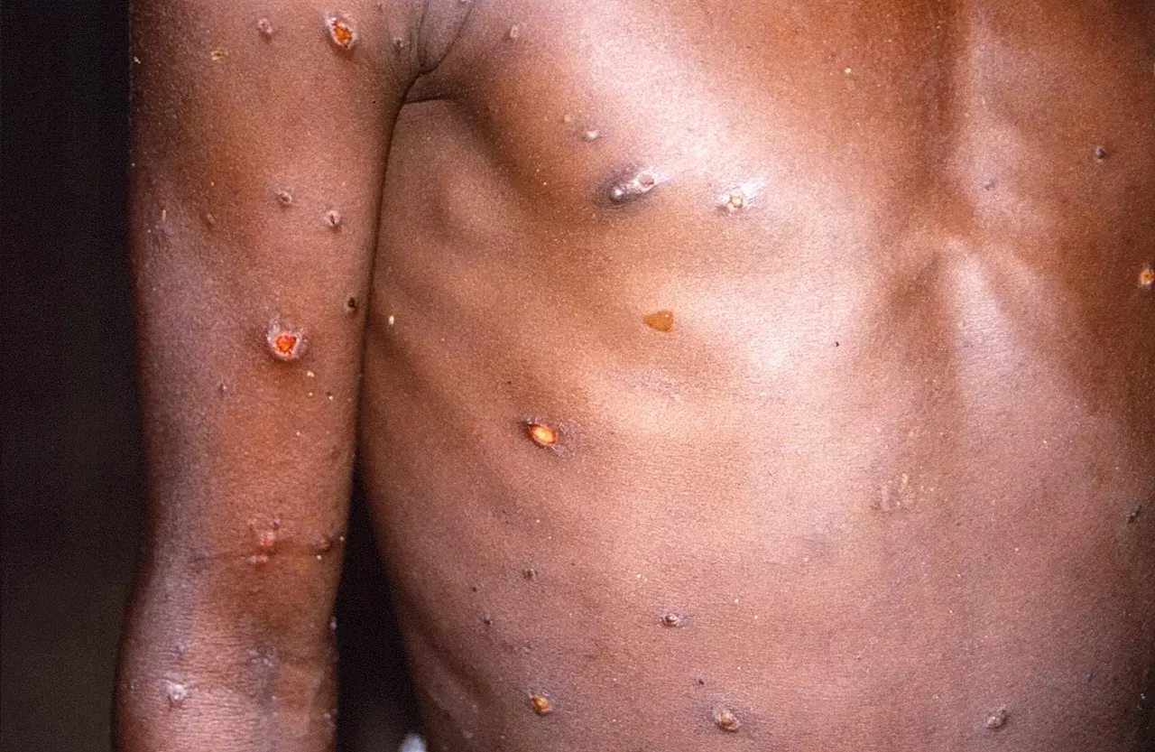 África declara la emergencia de salud pública por el brote de mpox