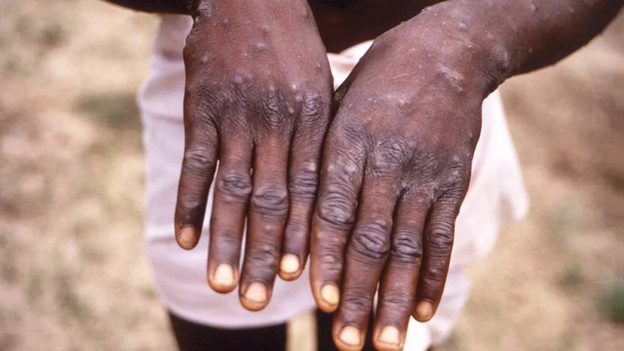 Africa's health watchdog declares mpox a public health emergency